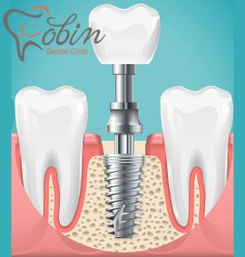 حقایق مهم در مورد ایمپلنت دندان